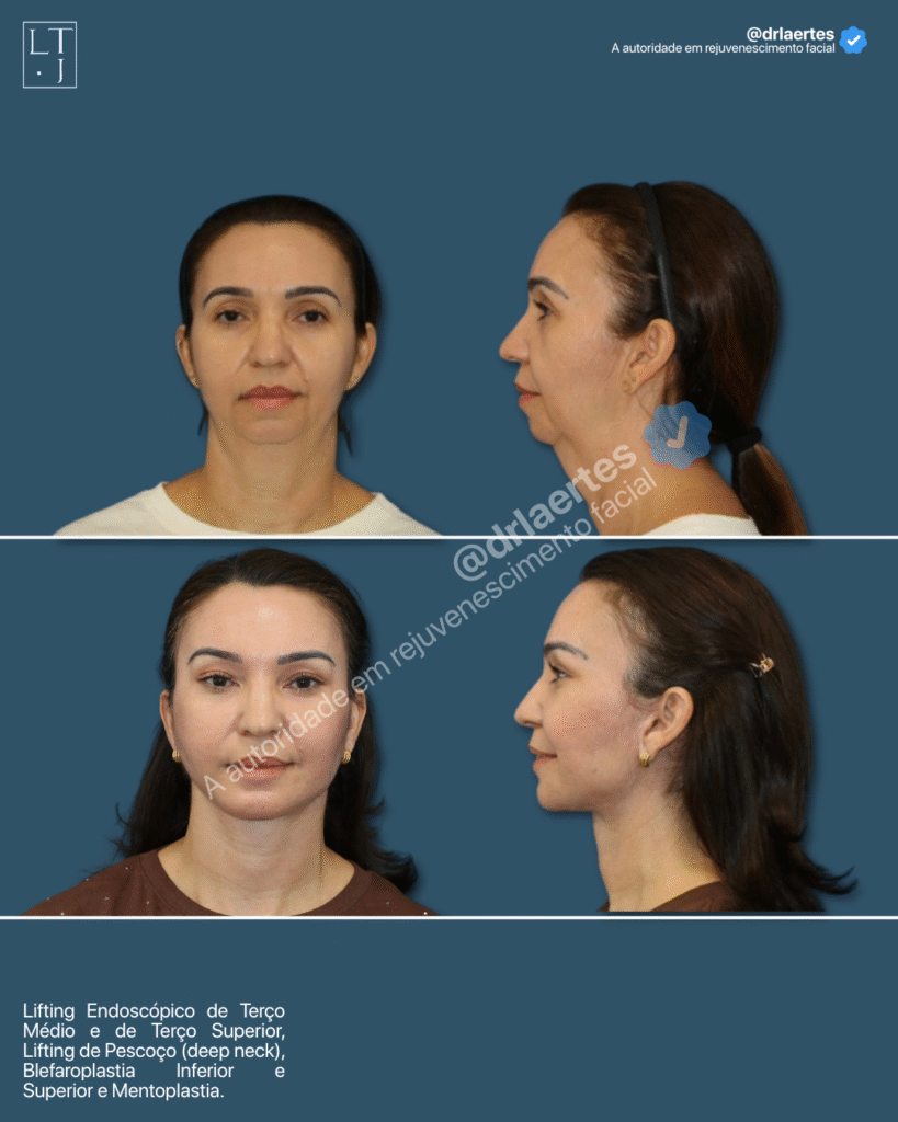 antes e depois do lifting facial